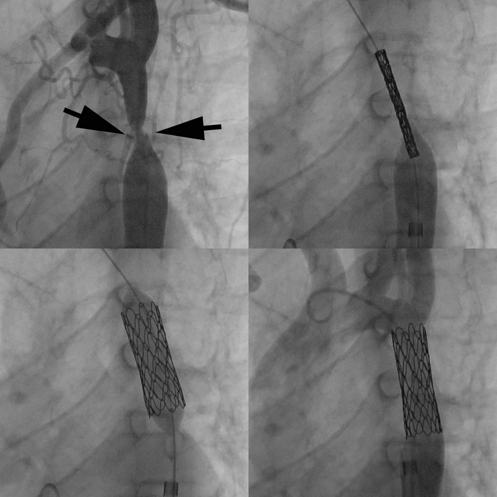 Cardiac Catheterization Program Pediatrics