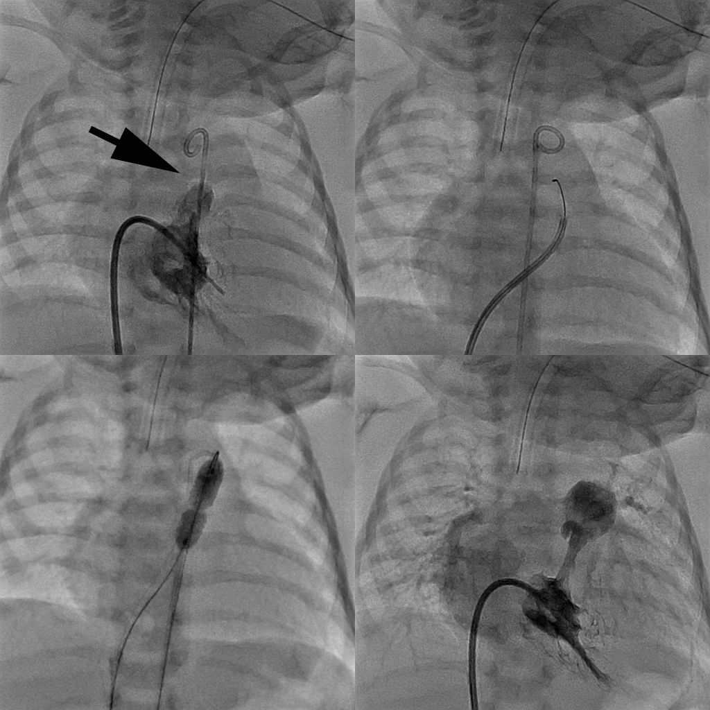 Cardiac Catheterization